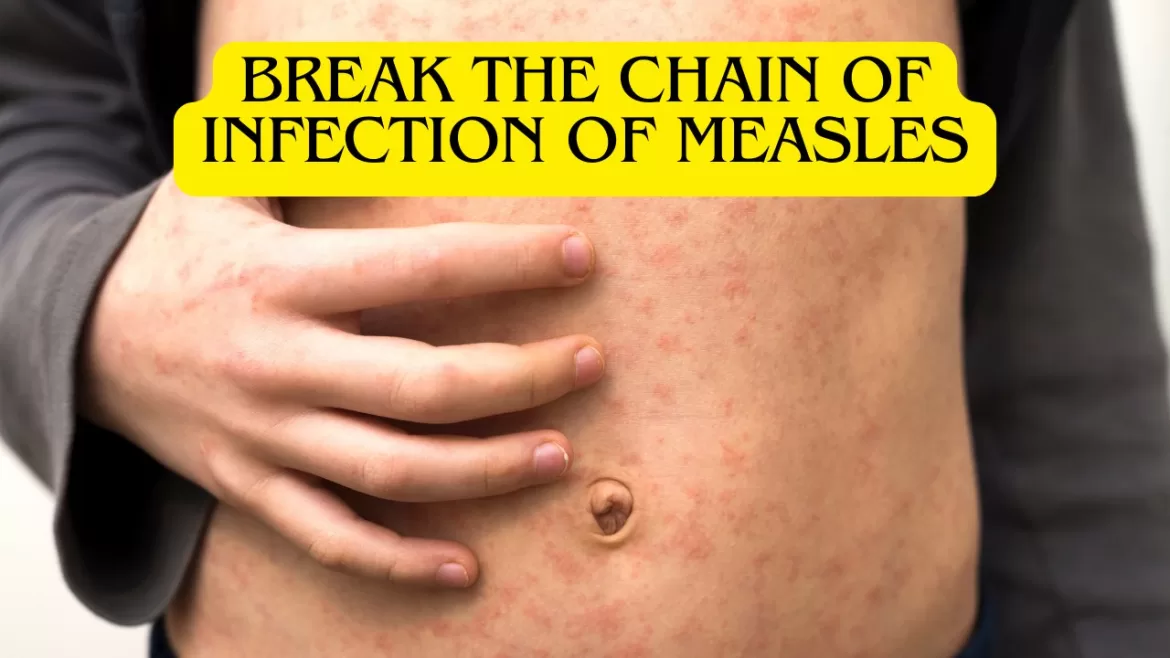 How to break the chain of infection of Measles How to break the chain of infection of Measles
